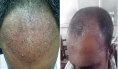 Photo of Risk And Side Effects Of FUE Hair Transplant Treatment