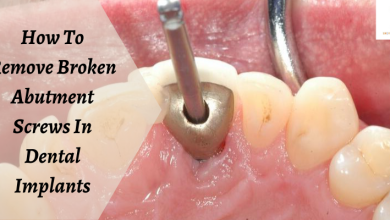 Photo of How To Remove Broken Abutment Screws In Dental Implants?