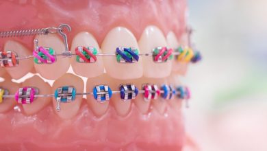 Photo of Tips for Selecting the Ideal Color Braces