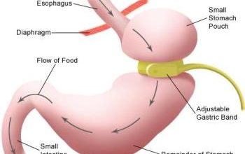 Photo of How a Hypno Gastric Band Works
