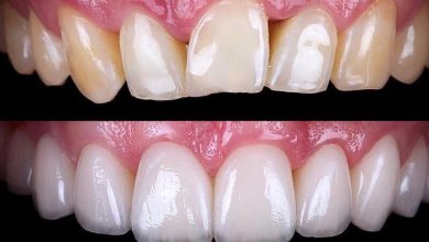 Photo of Porcelain Veneers – Everything You Need to Know