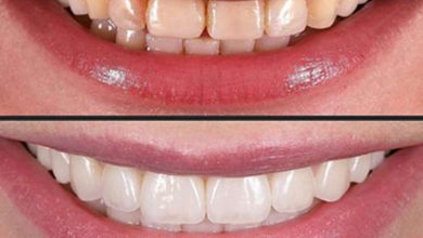 Photo of What You Need to Know About Porcelain Veneers