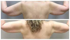 Photo of Find Out If Arm Liposuction Is Right For You